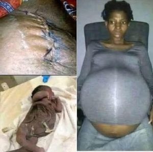 30-year-old woman in Georgia was declared brain dead……see More